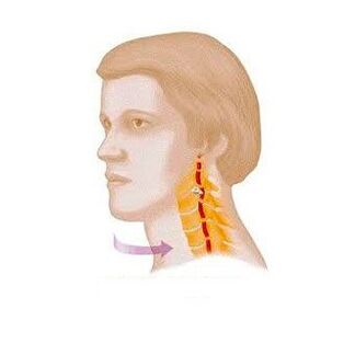 servikal osteokondroz bilan vertebral sindrom