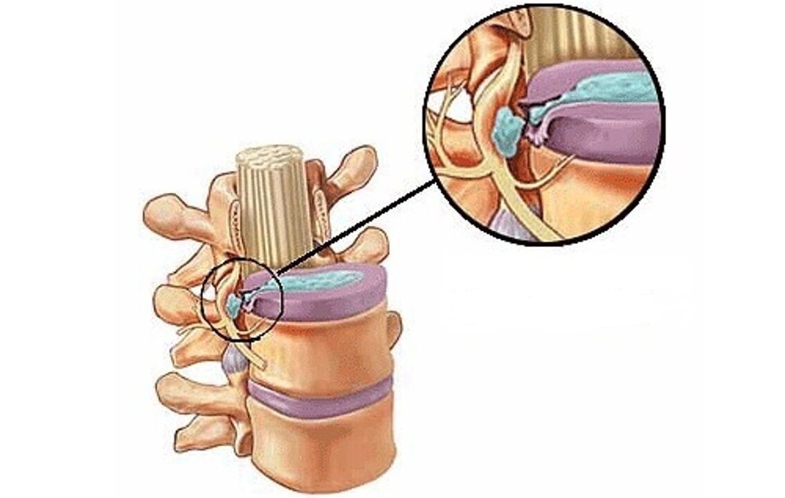 torakal osteoxondroz bilan intervertebral churra